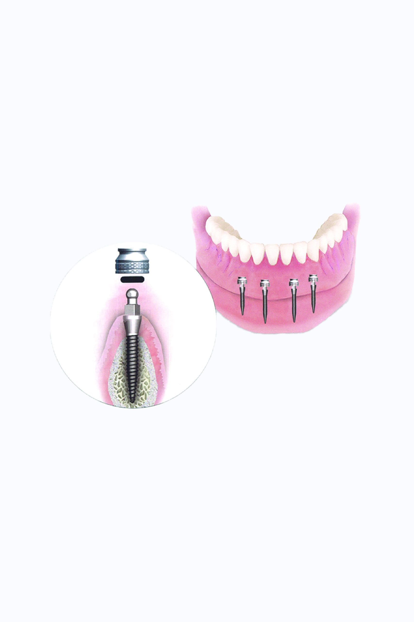 MINI Dental Burs