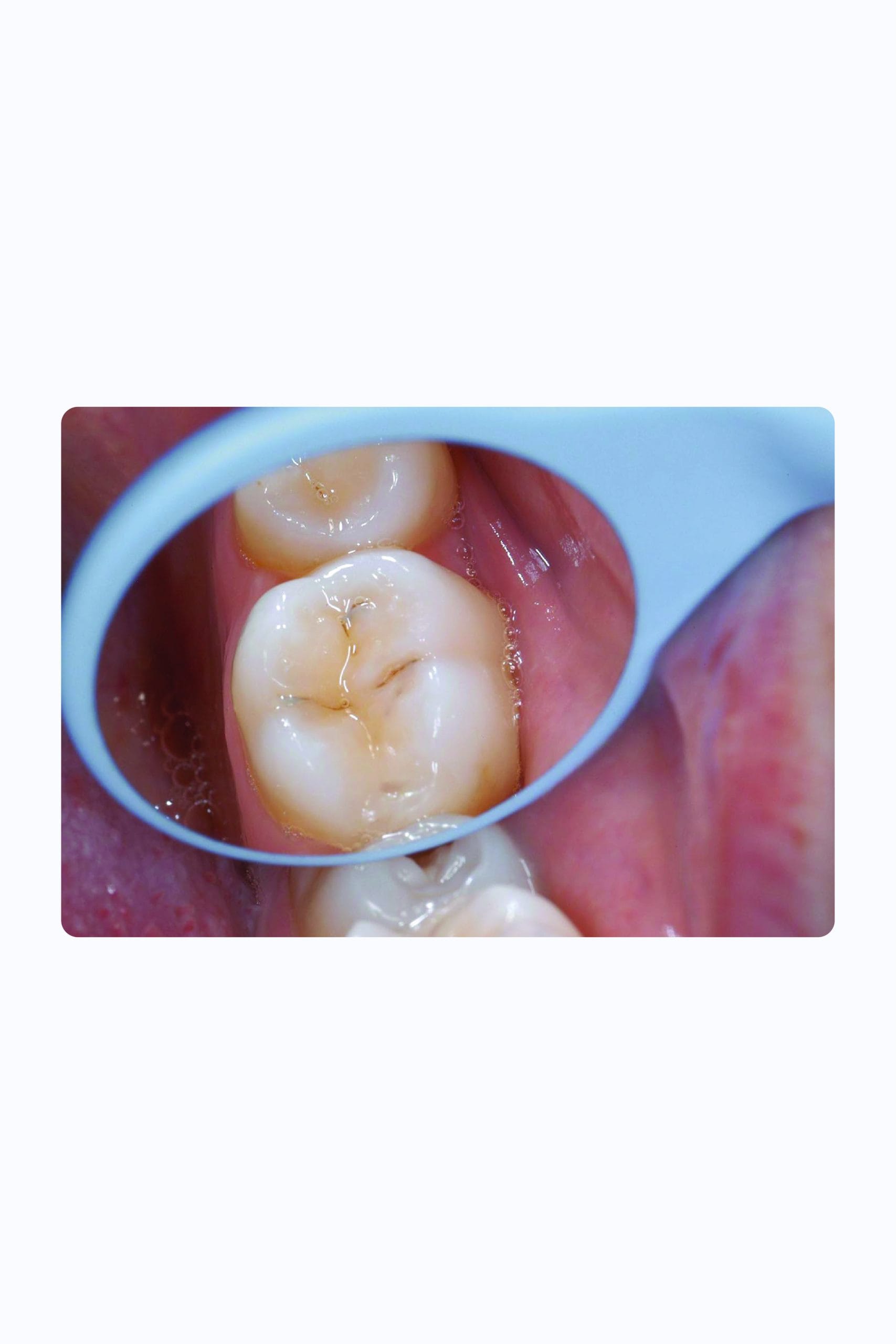 Relax Mouth Mirror